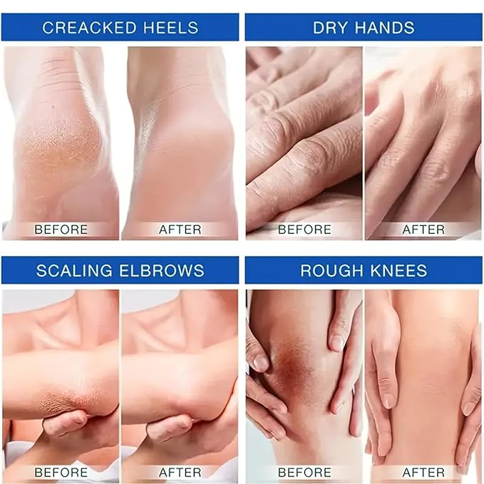 Urea Cream 45% Plus 2% Salicylic Acid, Callus Remover Foot Moisturizer Hand Foot Cream For Dry Cracked Feet from Toes to Heels Elbows Knees Softens Skin Exfoliates Dead Skin Smoothing Skin