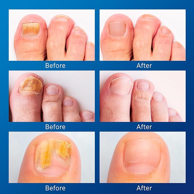 Toenail Fungus Treatment Extra Strength: (Medium) 64 Nighttime Hydrogel Patches for Overnight Repair - Visible Results in 8 Hours - Fungal Nail Patches for Toenail Fungus