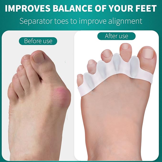 Pack of 10 Toe Separator, Silicone Toe Spacers for Correct Toe Alignment, Toe Spreader for Bunions Correct, Restore Overlapping Toes to Original Shape(Size: XL)