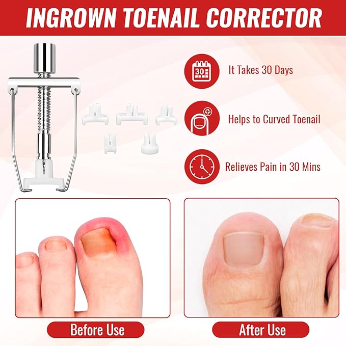 Ingrown Toenail Removal Kit, Ingrown Toenail Tool Kit with Ingrown Toenail Corrector, Ingrown Toenail Drops, Corrector Patch, Toenail Clipper, Nail File Lifter Tools