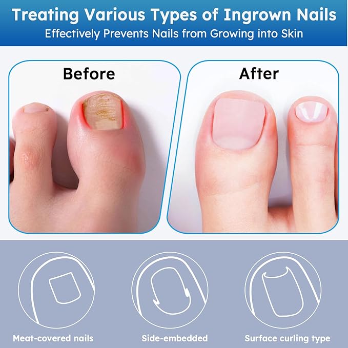 Ingrown Toenail Treatment, No Glue Breathable Curved Toenail Corrector,Ingrown Toenail Corrector Strips with File and Lifter, Professional Nail Correction Stickers 60Pcs
