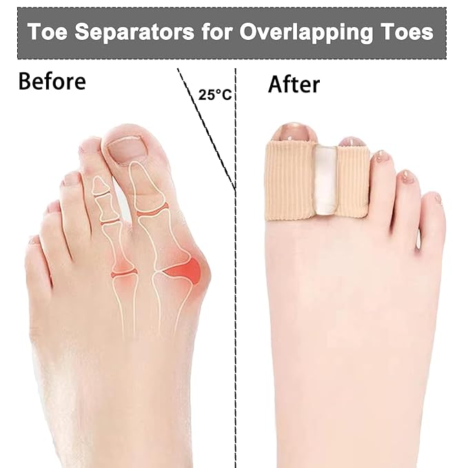 2PCS Gel Toe Separators for Overlapping Toes, Toe Spacers for Bunions Bunion Corrector for Women and Men, 2 Loops Bunion Corrector for First Two Toes