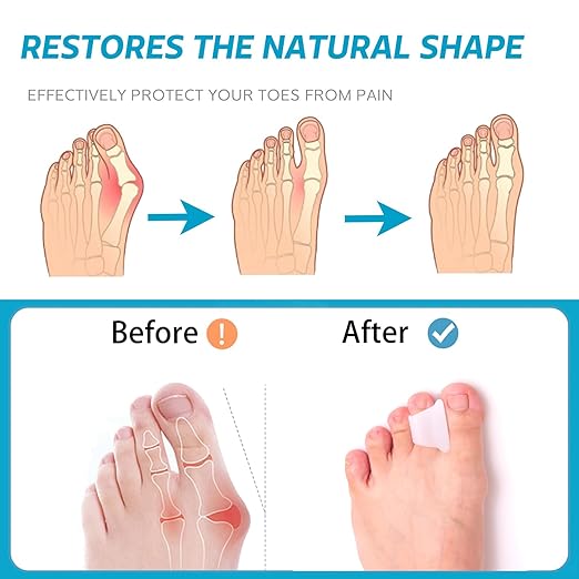 Hammer Toe Straightener Corrector - Toe Spacers Toe Separators for Bunion, Curled Toes, Hammertoes, Toe Corrector Toe Splint for Men and Women,6 Pack (Large Size)