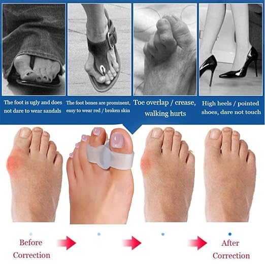 10 Pieces Bunion Corrector for Overlapping Toes, Silicone Toe Separators with 2 Loops, Big Toe Spacer Suitable for Bunion and Corrector and Spacer