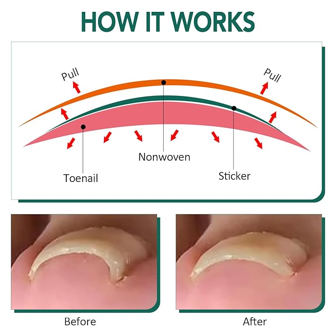 100pcs Ingrown Toenail Treatment, Breathable Ingrown Toenail Strips Ingrown Toenail Stickers, Toenail Corrector Patch with 3 Pedicure Tools for Ingrown Toenail