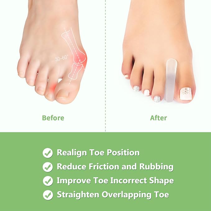 Niupiour Silicone Big Toe Separator for Bunion, 10 Pack- Large Toe Spacer for Women and Men, Flared Design Toe Straightener for Aligning Toes and Correcting Toe, Prevent Blisters, Calluses and Corns