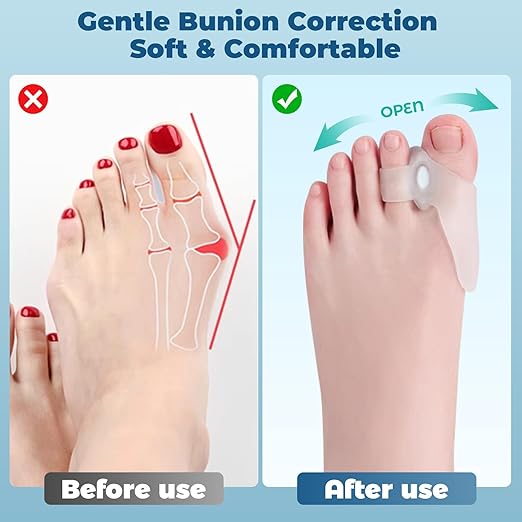 Adjustable Bunion Corrector Kit & Toe Separator for Women and Men, Big Toe Straightener, Pain Relief for Bunions, Hammer, Overlapping Toes, with Modules - Bunion Corrector and Spacers