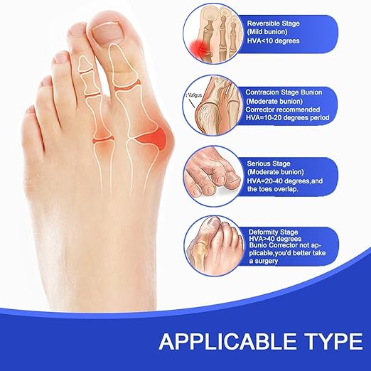 Toe Corrector Toe Separator Bunion Splint 【Updated Version】 Hallux Valgus Big Toes Corrector Set Bunion Brace Bunion Exercise Strap Orthopedic Kit Pain Relief (Blue, free)