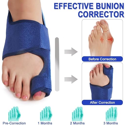 Toe Corrector Toe Separator Bunion Splint 【Updated Version】 Hallux Valgus Big Toes Corrector Set Bunion Brace Bunion Exercise Strap Orthopedic Kit Pain Relief (Blue, free)