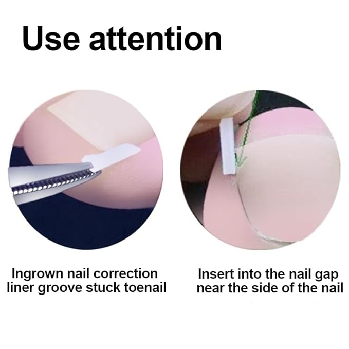 Professional Ingrown Toenail Toolkit with Breathable Ingrown Toenail Strips, Curved Toenails Corrector Patch, Painless File and Lifter for Home Pedicure Care