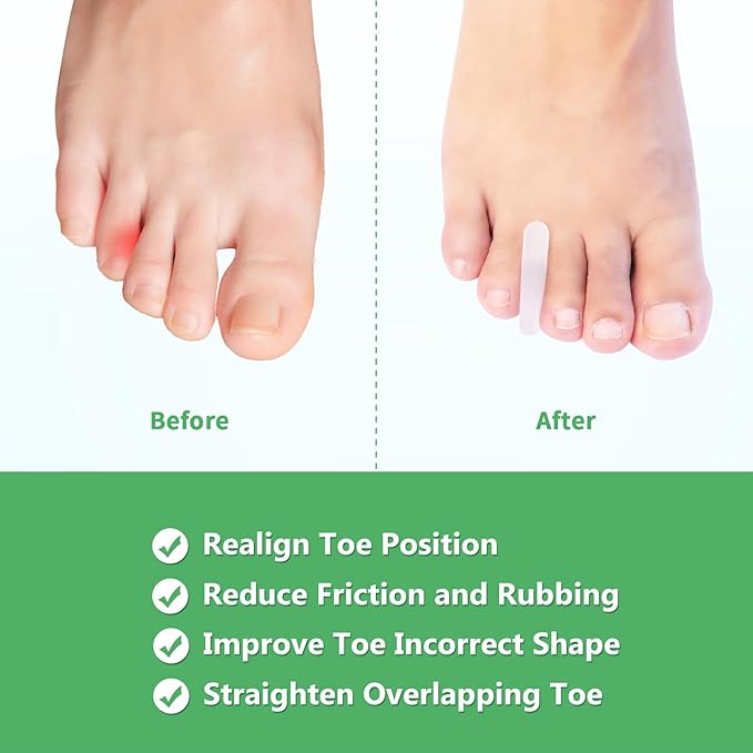 Niupiour Medium Toe Separator for Bunion, 10 Pack- Small Silicone Toe Spacer for Women and Men, Flared Design Gel Toe Straightener for Aligning Toes and Correcting Toe, Relief Foot Pain
