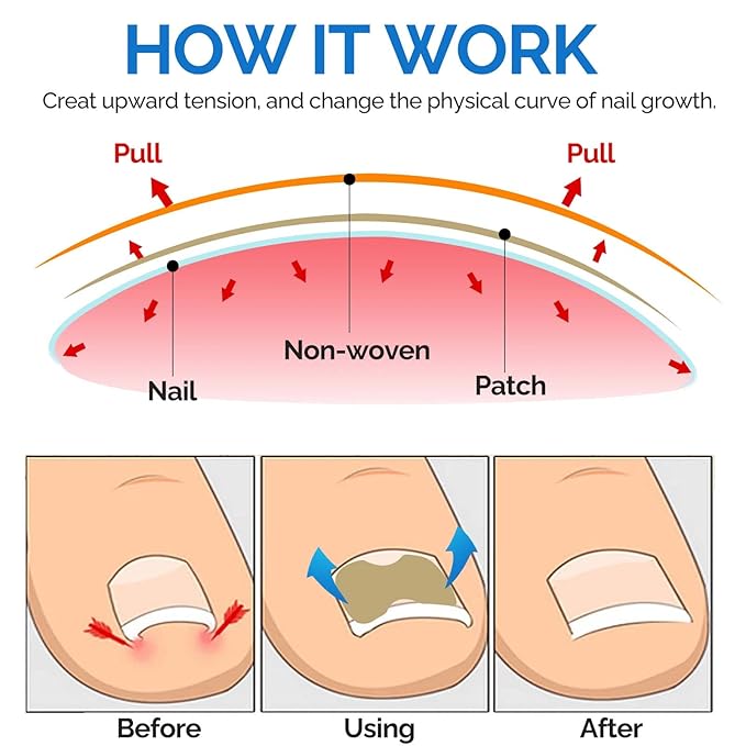 Ingrown Toenail Treatment, 50Pcs Ingrown Toenail Removal Kit with File and Lifter, Professional and Fast Acting