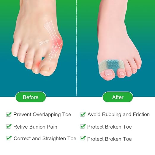 4-Pack SEBS Toe Spacers & Separators for Men & Women – Bunion Relief, Overlapping Toe Correction, Reusable (2blue+2color)