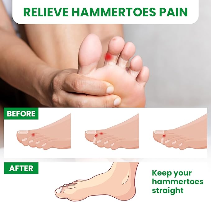 Bukihome Hammertoe Corrector - 6 Pack Toe Straightener to Curled Toes, Broken toe, Bunion Corrector for Women and Men, Large Size (Clear)