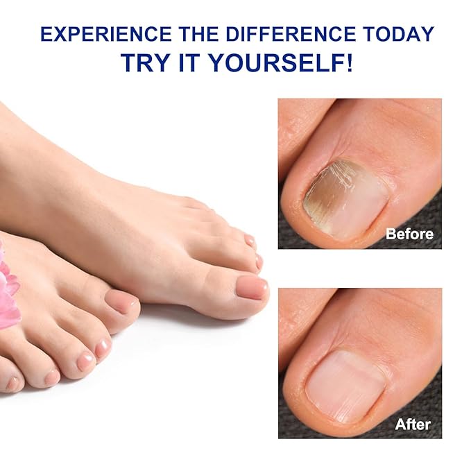 2Pack Toenail Treatment Extra Strength - 64 Pcs Nail Patches, 8-Hrs Overnight Nail Repair, Safe for Sensitive Skin, Easy to Apply