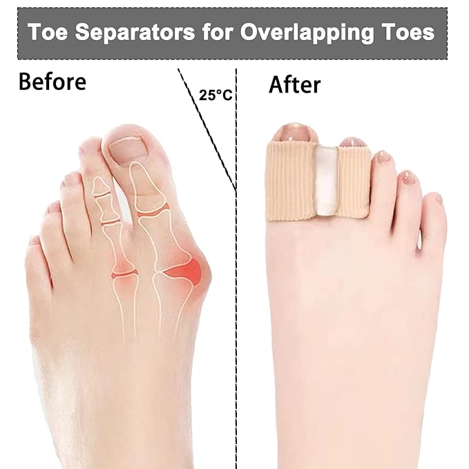 12 Packs Gel Toe Separators for Overlapping Toes, Toe Spacers for Bunions Bunion Corrector for Women and Men, 2 Loops Bunion Corrector for First Two Toes