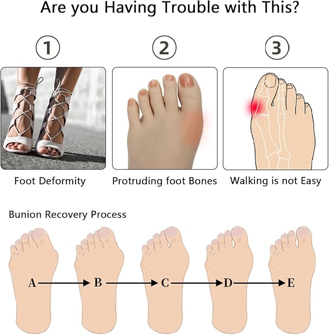 Kingjie Silicone Toe Spreaders for Men & Women - Correct Curled Toes, Bunion & Hammer Toe Support, Reusable & Washable Adjustable Unisex Toe Spacer（4 Pack） (White + Skin Color)