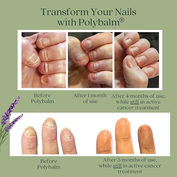 – CLINICALLY PROVEN Nail Protection | 100% NATURAL | Doctor Developed | Strengthen & Repair Nails Damaged by Chemo, Manicures & Aging | Antioxidant, Anti-Fungal & Anti-Inflammatory Properties
