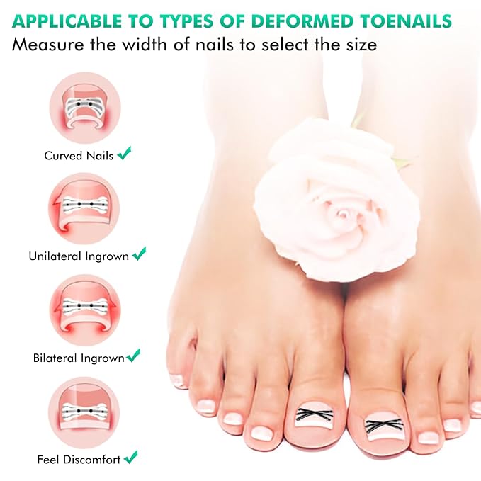 Ingrown Toenail Correctors Tripled, Quick Relief Ingrown Toenail Treatment Removal Tool Kit at Home, Curve Correct for Big Toe Ingrown Nail Outgrow Lifter Sticks To The Nail 0.59/0.66in