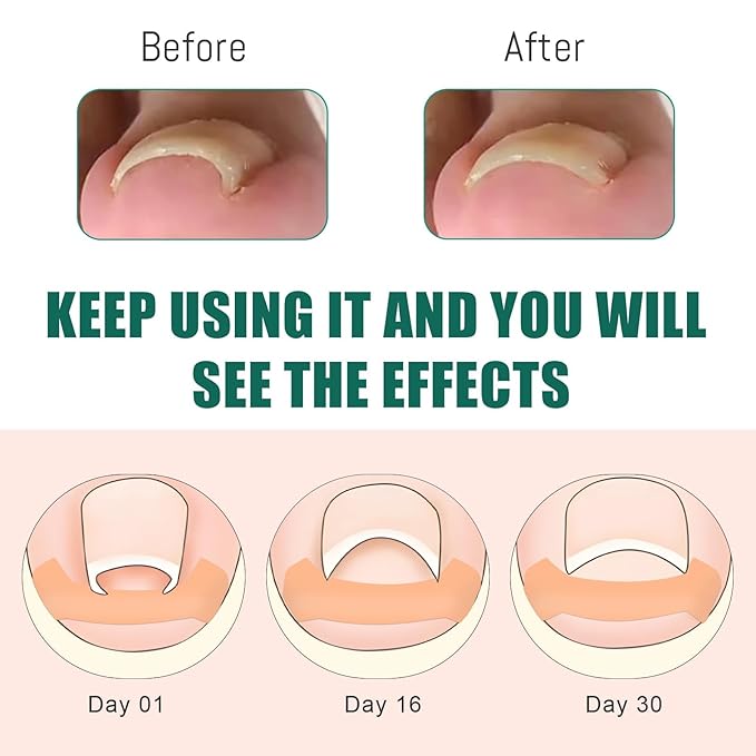 Ingrown Toenail Treatment, 60Pcs Breathable Ingrown Toenail Strips,Painless Ingrown Toenail Tool, Professional Pedicure for Ingrown Toenail, Toenail Corrector Patch