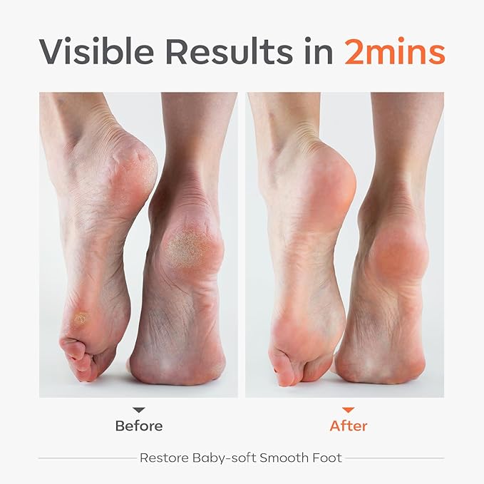Modelones Glass Foot File, Professional Foot Scrubber and Callus Remover, Heel Scraper for Cracked Heels, Dead Skin Remover, Foot Buffer for Soft Feet, Safe Pedicure Tool with Anti-Slip Handle