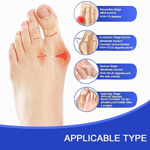 Toe Corrector Separators Bunion Splint 【2025 Updated】 Hallux Valgus Big Toes Corrector Set Bunion Brace Exercise Strap Orthopedic Kit Foot Pain Relief