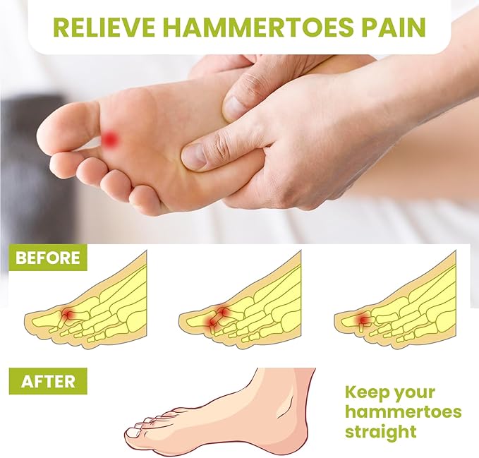 Bukihome Hammertoe Corrector Gel Toe Straighteners - 12 pcs Support Crest for Women & Men - Realign Bent, Crooked, Curled, Claw, Hammer Toes - Beige,Multi-Size