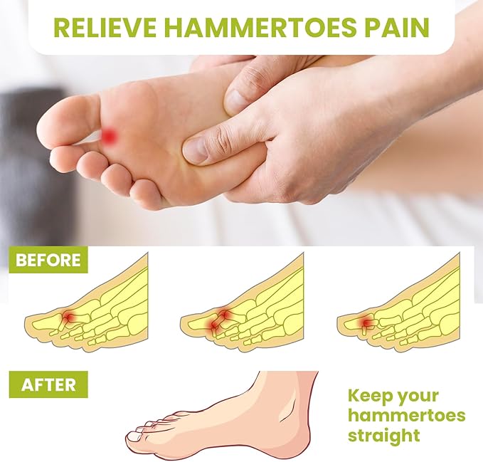 Bukihome Hammertoe Corrector Gel Toe Straighteners - 12 pcs Support Crest for Women & Men - Realign Bent, Crooked, Curled, Claw, Hammer Toes - Beige,Single Loop