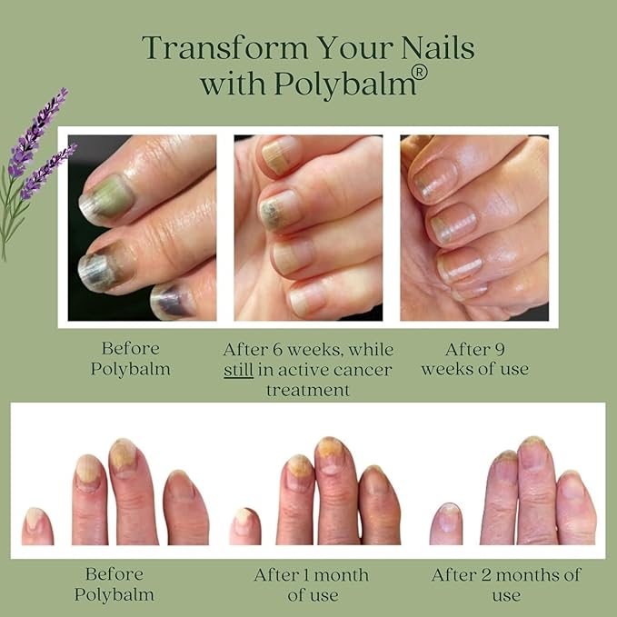 – CLINICALLY PROVEN Nail Protection | 100% NATURAL | Doctor Developed | Strengthen & Repair Nails Damaged by Chemo, Manicures & Aging | Antioxidant, Anti-Fungal & Anti-Inflammatory Properties