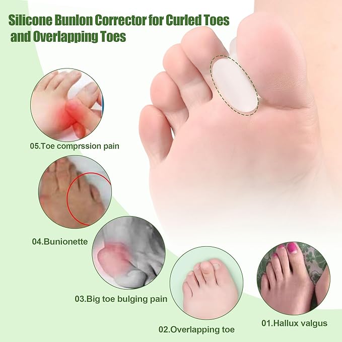 FOYOLO Gel Toe Separators and Flared Bunion Spacers 8PCS Temporary Bunion Corrector,Toes Splint Gel Toe Spacers for Overlapping Toe and Curled Toes,Stay in Place-(2 Small & 6 Large Size-Clear)