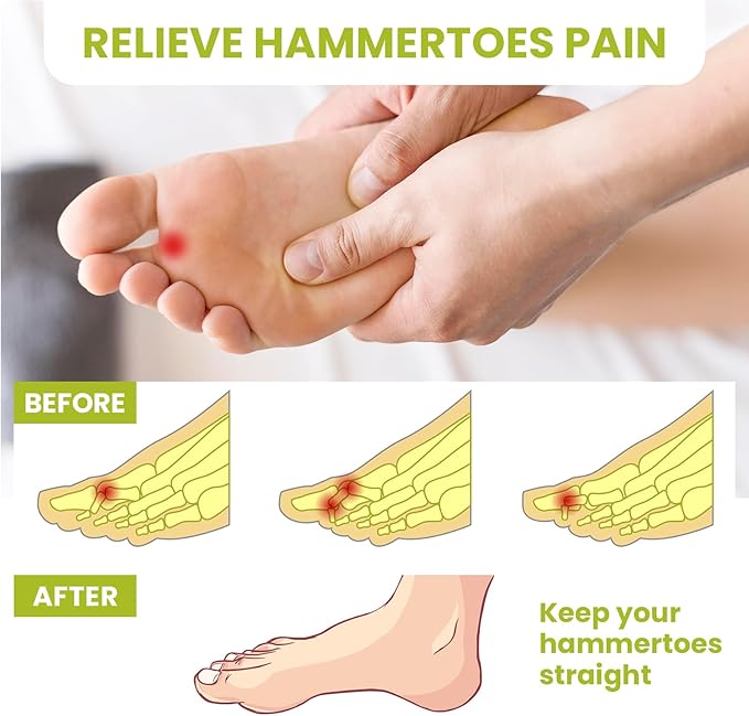 Bukihome Hammertoe Corrector Gel Toe Straighteners - 12 pcs Support Crest for Women & Men - Realign Bent, Crooked, Curled, Claw, Hammer Toes - Clear,Multi-Size