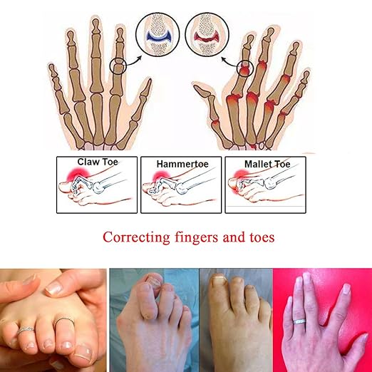 6 Pieces Broken Toe Wrap, Hammer Toe, Elastic Fabric Toe Splint Toe Straightener, Toe Cushioned Bandages Finger Protectors Straightener Hammer Toe Separators