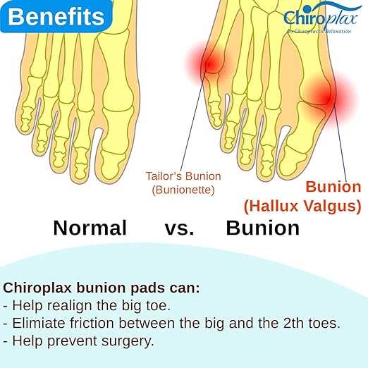 Chiroplax Bunion Corrector Pads Silicone Big Toe Separator Straightener Spacer for Women & Men Hallux Valgus Pain Relief Sleeve Cushion Splint Protector (4 Pads w/Shims - Medium)