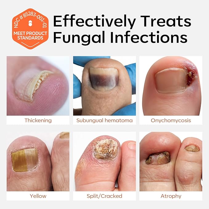 modelones Toenail Fungus Treatment Extra Strength 7days Nail Fungus Treatment for Toenail and Fingernail With Brushes Head Nail Repair for Damaged Nails Antifungal Nail Polish 30ML 1Fl Oz