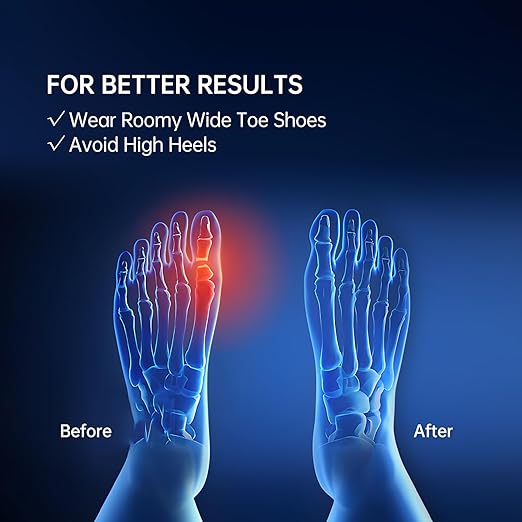Bunion Toe Corrector Spacer for Women, Pack of 10 Soft Gel Big Toe Separators for Bunion Relief