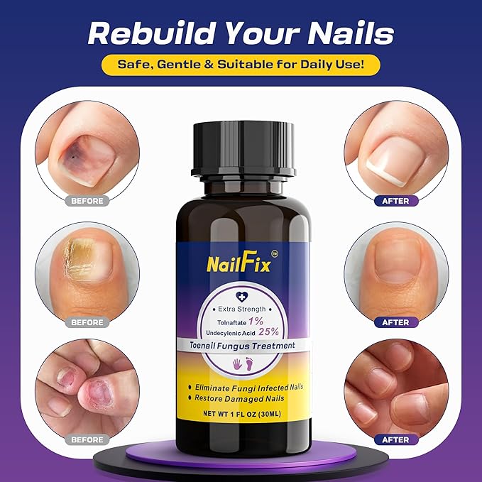 Toenail Fungus Treatment Extra Strength - Upgraded Toe Nail Fungus Treatments, Antifungal Nail Treatment with 25% Undecylenic Acid & Tea Tree Oil - Damaged Nails Foot Fungus Treatment Extra Strength