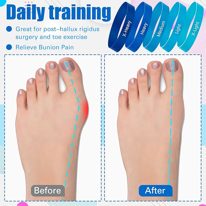 Set of 5 Toe Stretcher Bands for Bunions Correction Foot Big Toe Spacers Resistance Straightener Loop Bands with Carry Bag for Women Men Hallux Valgus Alignment Yoga Exercise(Blue)