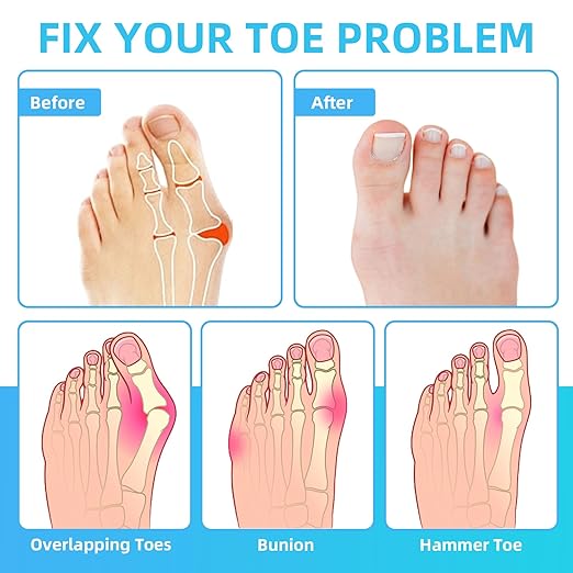 6 Pcs Hammer Toe Corrector,Toe Straighteners For Crooked Toes,Toe Spacers For Women Men,Hammer Toe Corrector For Crooked Toes,Bunion,Hammer Toes(Clear,One Size)
