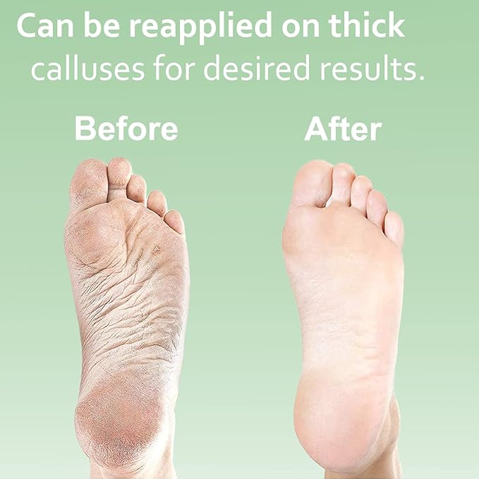 Dr. Entre's Callus Remover Gel Kit for Feet: Foot File, Pumice Stone, 5 Glove Pairs for Gel Application, Spa Kit, Foot Care, Pedicure Tools, Scrubber, 8oz