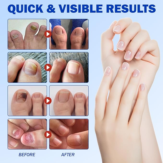 Nail Patches, 42 Pcs Toenail Treatment Extra Strength 8-Hour Overnight Nail Fast Acting Repair for Damaged & Discolored Nails Overnight Renewal Effortless Hydrogel Nail Care for Men and Women