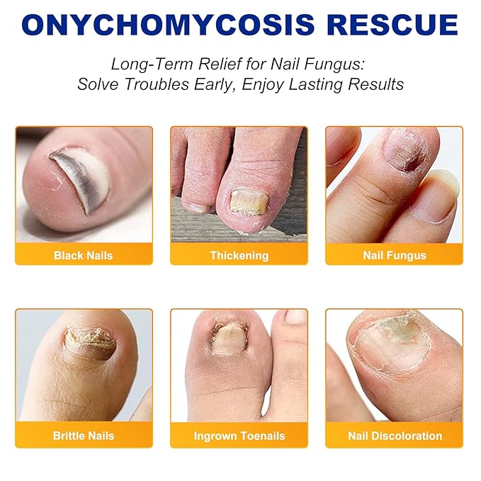 32 PCS Fungal Nail Patches for Broken Damaged Split Nails,Toenail Treatment Extra Strength,Nail Repair for Damaged Nails, Nails Care Supplies, Restore Discoloration and Thickness (2 Pack)