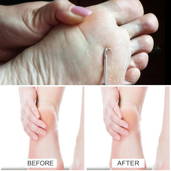 Stainless steel Corn Remover Drill Bit Medical Pedicure Faster Removal Cracked Skin Foot Callus Cuticle Cutter Toothed Bits Sanding Polishing Head,Feet Filing Nails for Manicure (2.8mm)