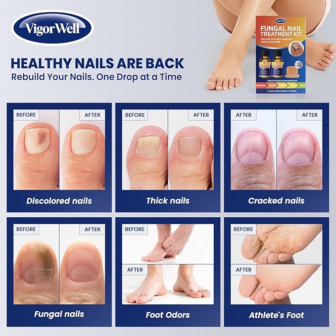 Toenail Fungus Treatment Extra Strength: Dual Action Nail Repair Kit for Thick, Brittle or Discolored Nails - 30 ml Nail Repair Gel with 25% Undecylenic Acid - (Medium) 32 Fungal Nail Patches