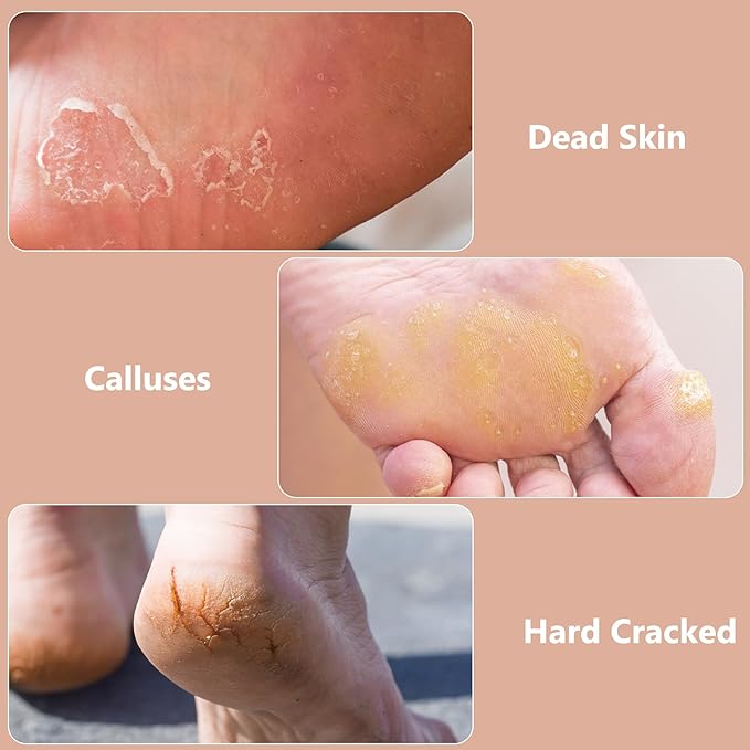 OWIIZI Foot File Pedicure Foot Scrubber for Callus Remover, Stainless Steel Foot Exfoliator Grater Feet Rasp Scraper Hard Cracked Dead Skin Removers for Wet and Dry Foot
