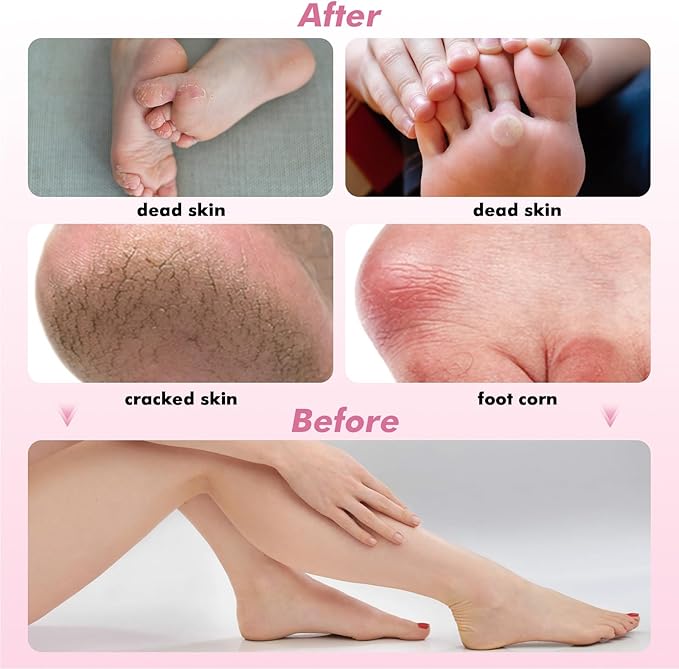 2 in1 Electric Foot Callus Remover Waysse Callus Remover for Feet with Replacement Sandpaper Discs, Adjustable Speed Electric Foot File Professional Pedicure Tool for Dead Skin Calluses