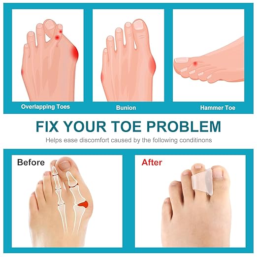 6Pcs Hammer Toe Straightener Corrector,Toe Straighteners for Curled Toes,Toe Spacers for Women Men Hammertoe Corrector for Crooked,Bunion,Hammer Toes(Clear Large Size)