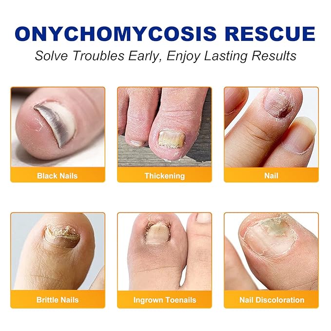 Toenail Treatment Extra Strength-8-Hrs Overnight Nail Repair,ingrown toenail treatment,Strengthens Brittle Nails,Improves Texture & Thickening Hypoallergenic Easy (32 Patch)