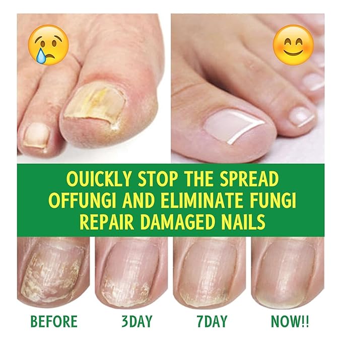 Ginger Nail Treatments, 7 Days Ginger Cuticle Care Oil for Nails for Strengthen nails & Promote Nail Growth, Natural Plant Formula（2PCS)