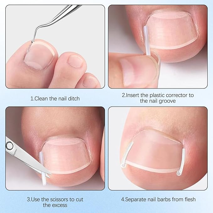 Ingrown Toenail Corrector Set with Correction Strips, Professional Ingrown Toenails Pedicure Tool Set, Painless File and Lifter Pedicure Tools Pedicure Tools,Ingrown Nail Tool for Women Man