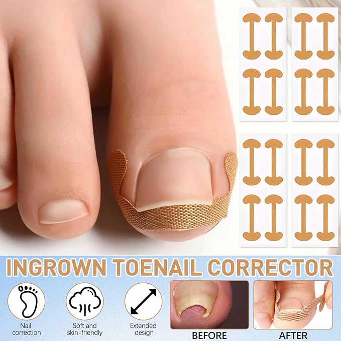 Ingrown Toenail Corrector Set with Correction Strips, Professional ingrown toenails pedicure tool set for men and women